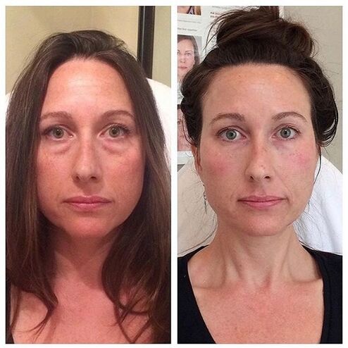 Nena antes e despois do rexuvenecemento facial con láser