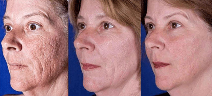 Resultado despois do procedemento de rexuvenecemento da pel facial por láser
