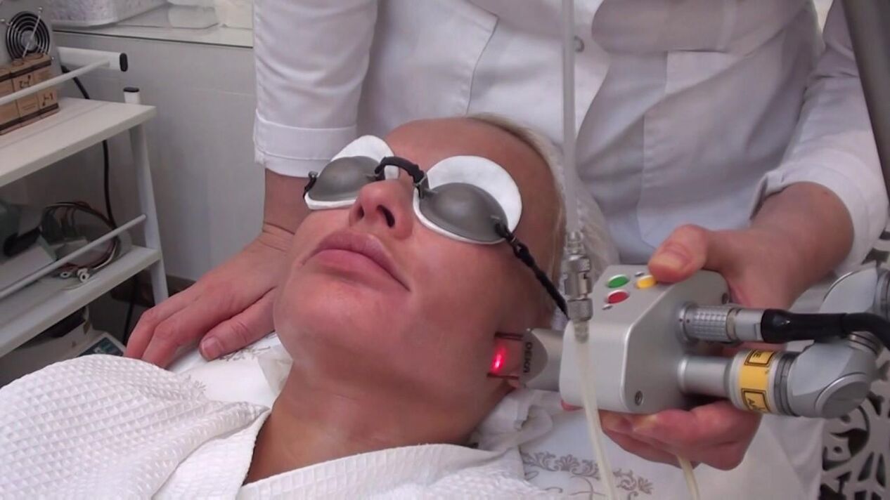 Tratamento cun raio láser de áreas problemáticas da pel da cara