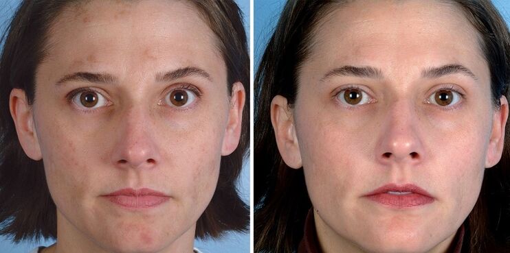 antes e despois do rexuvenecemento da pel co dispositivo