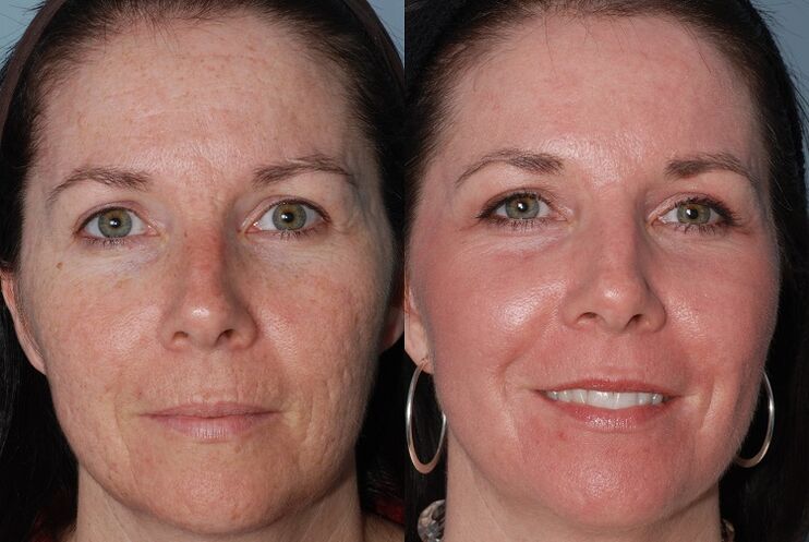 antes e despois do rexuvenecemento da pel por hardware