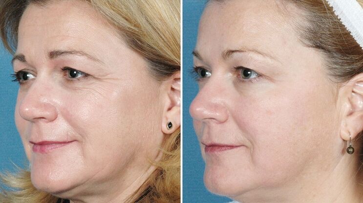 fotos antes e despois do rexuvenecemento da pel por hardware